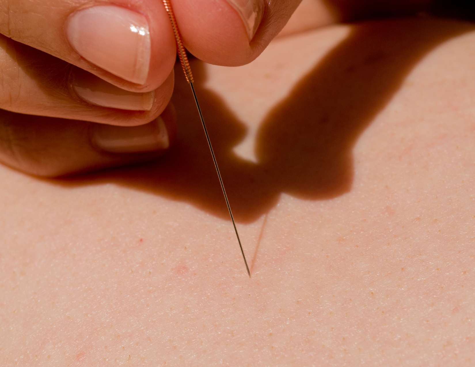 The Best Acupuncture Points for Hip Bursitis